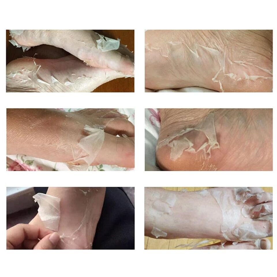 Ayt Sunup SN-26965 Ayak Peeling Maskesi Nasır Ö lü Deri Egzama Giderici 1 Çift Ayak Nemlendirici Özellikli